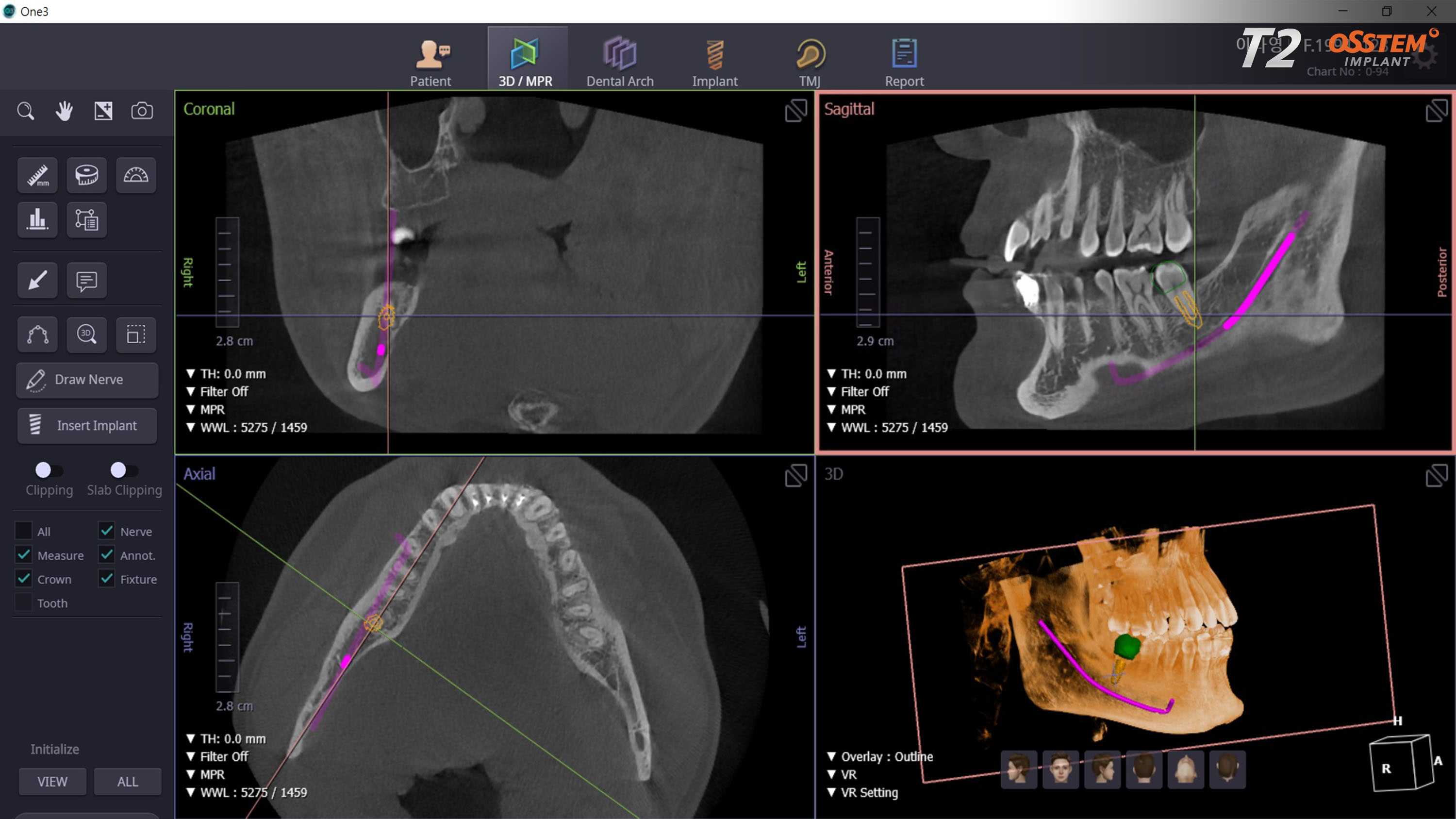 Close-up of 3D CBCT scan results showing jawbone detail for implant planning at Trust Dental Surgery