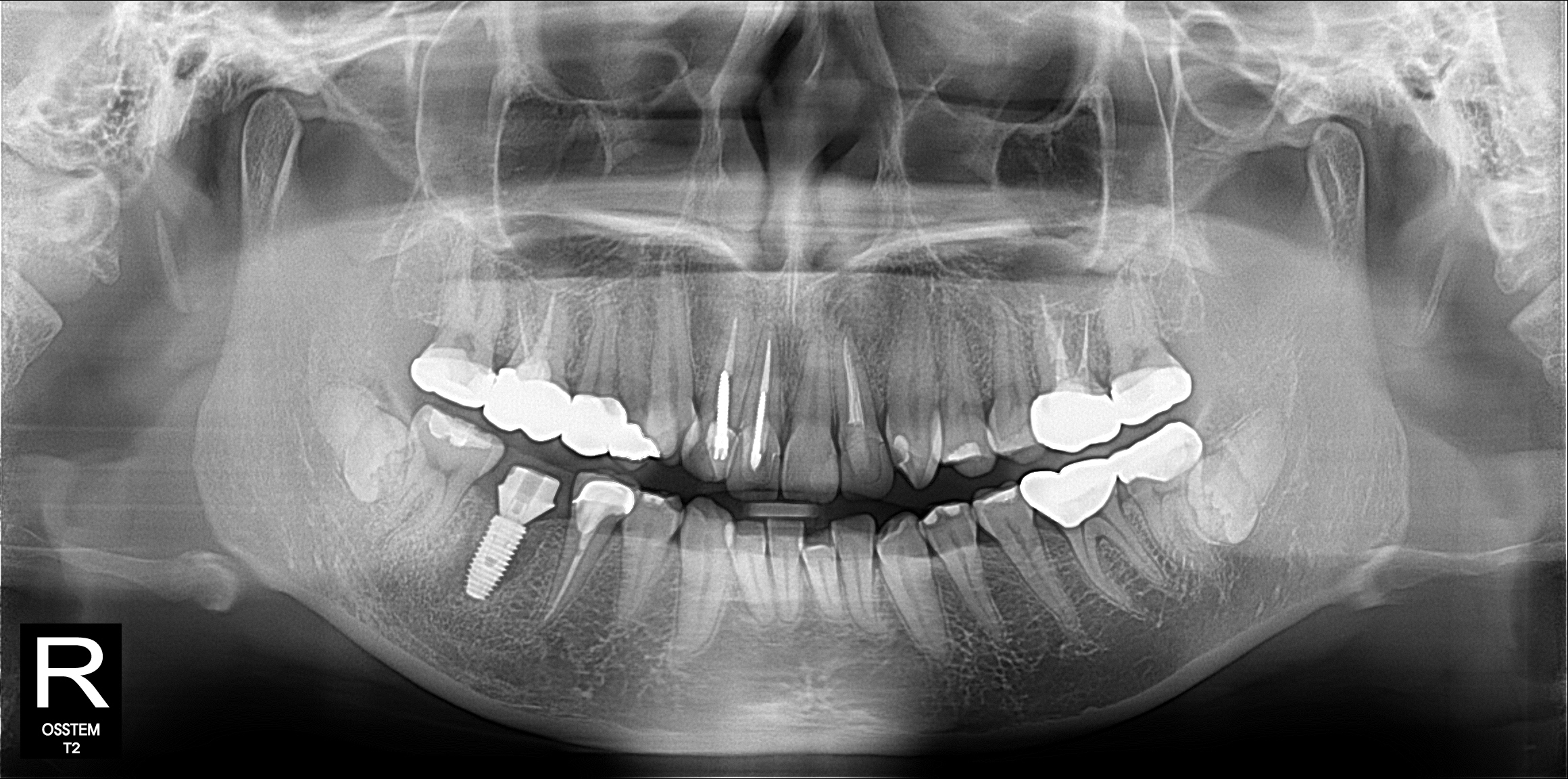 OPG panoramic X-ray used to assess bone levels and plan tooth replacement at Trust Dental Surgery