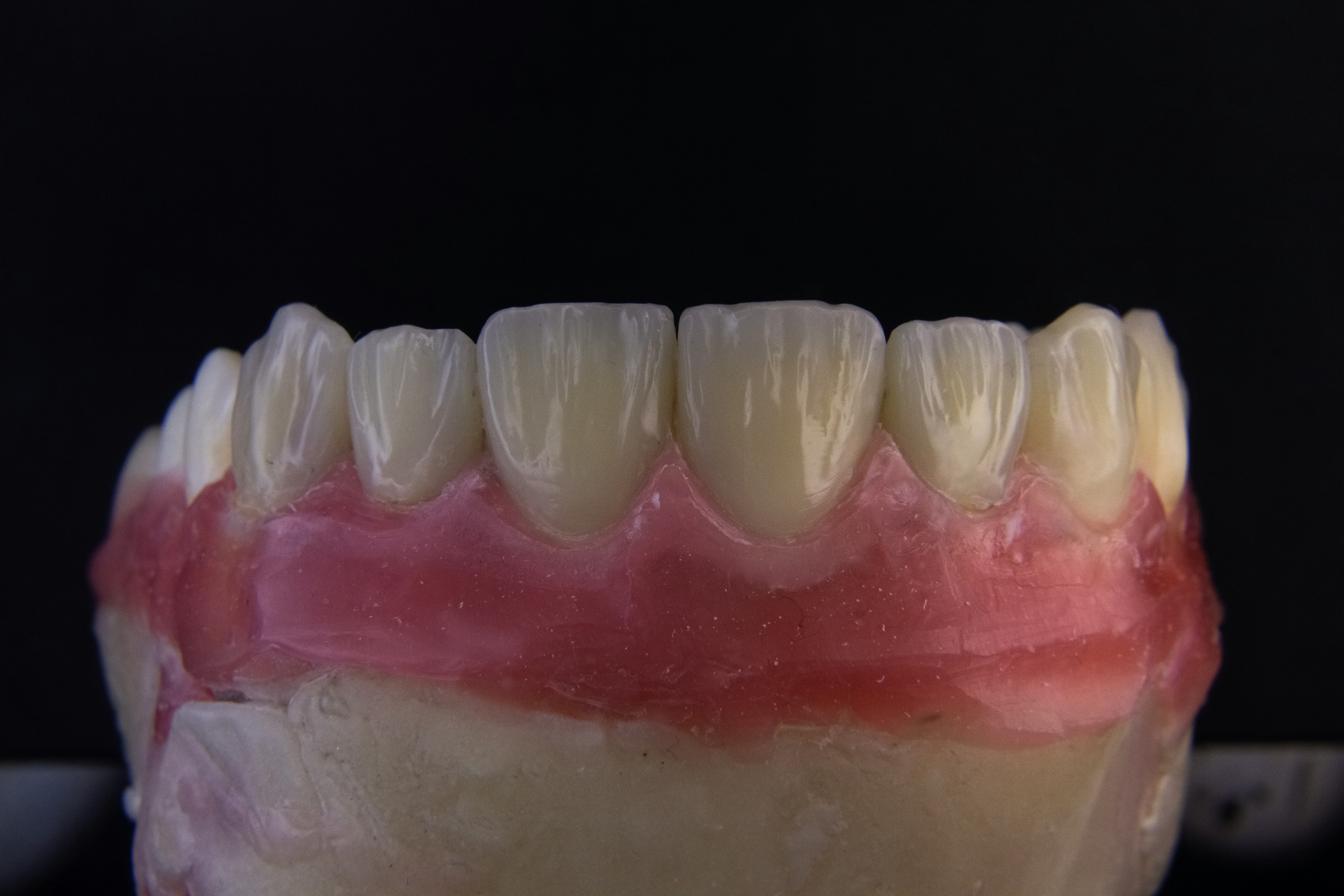 Acrylic overdenture on a dental cast model showing natural-looking teeth and gum-coloured base