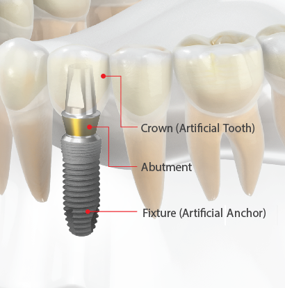 dental implant singapore