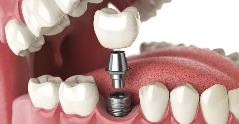 Single dental implant with Crown